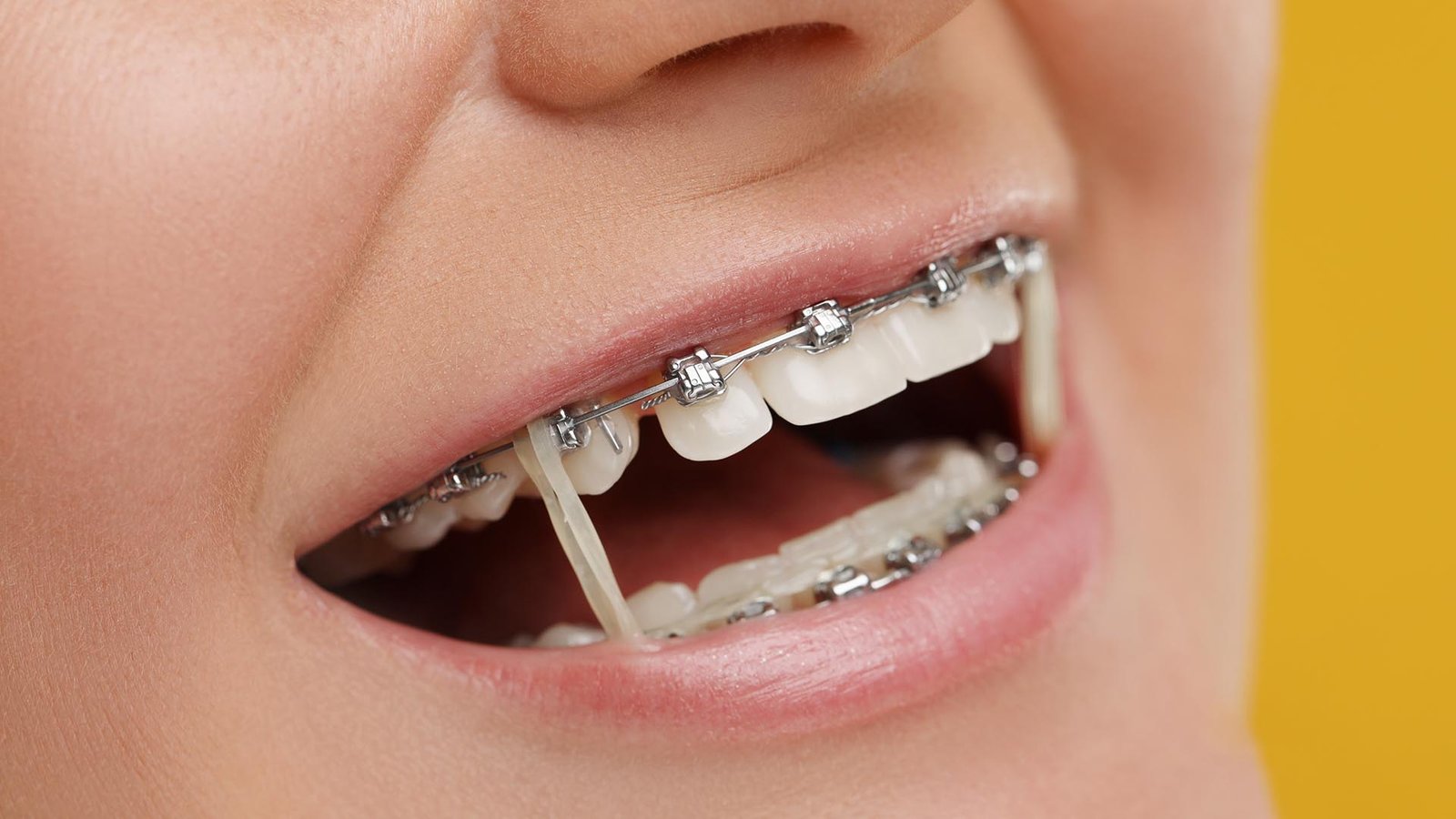 Dental Braces