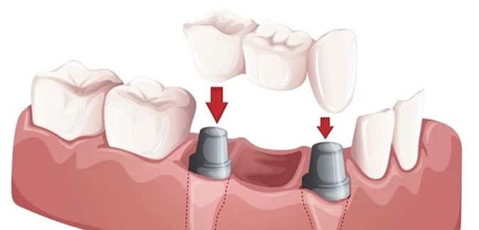 Dental Bridges