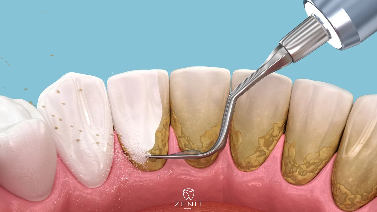 Dental Cleaning Process
