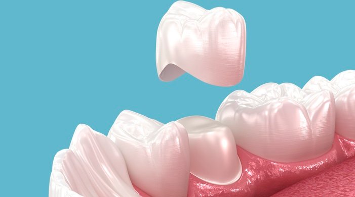 Dental Crowns