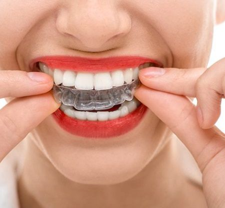 Invisalign